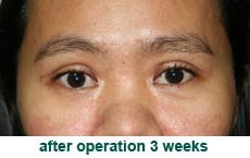 plastic-surgery-blepharoplasty